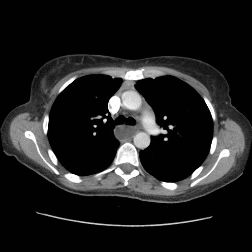 Aspiration pneumonia secondary to laparoscopic banding (Radiopaedia 18345-18183 A 17).jpg
