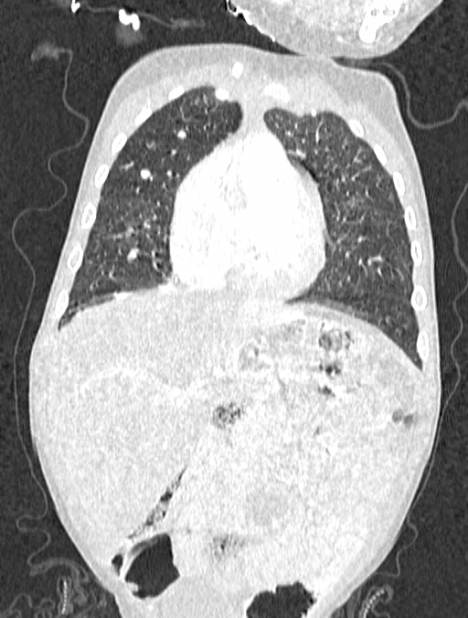 Asplenia syndrome (Radiopaedia 73083-83792 Coronal lung window 41).jpg