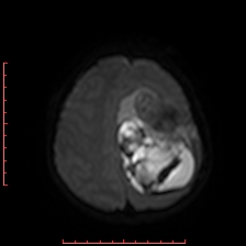 Astroblastoma (Radiopaedia 74287-85162 Axial DWI 81).jpg