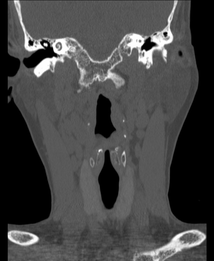 Atlanto-occipital assimilation with basilar invagination (Radiopaedia 70122-80188 Coronal bone window 38).jpg