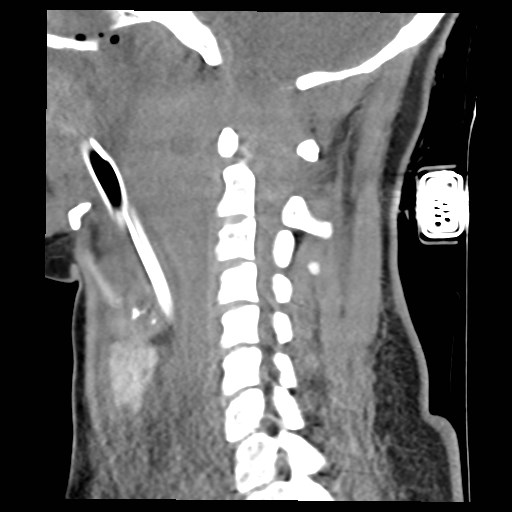 File:Atlanto-occipital dislocation (Radiopaedia 44648-48412 A 17).jpg