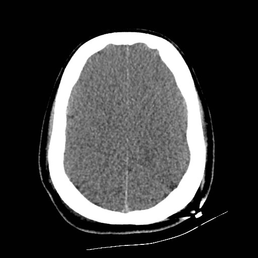 File:Atlanto-occipital dislocation (Radiopaedia 44648-48412 Axial non-contrast 42).jpg