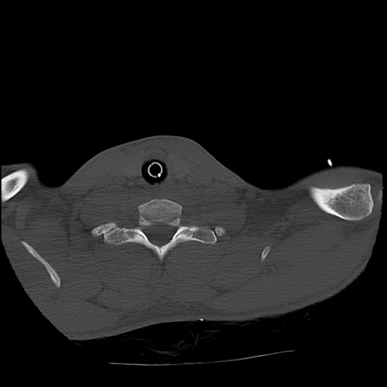 Atlanto-occipital dissociation (Traynelis type 1), C2 teardrop fracture, C6-7 facet joint dislocation (Radiopaedia 87655-104061 Axial bone window 81).jpg