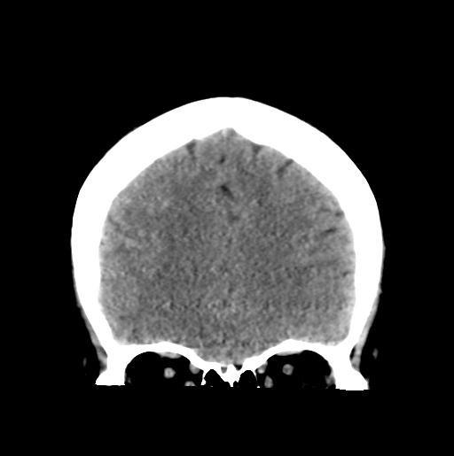 File:Atretic encephalocoele with inferior vermis hypoplasia (Radiopaedia 30443-31107 Coronal non-contrast 11).jpg