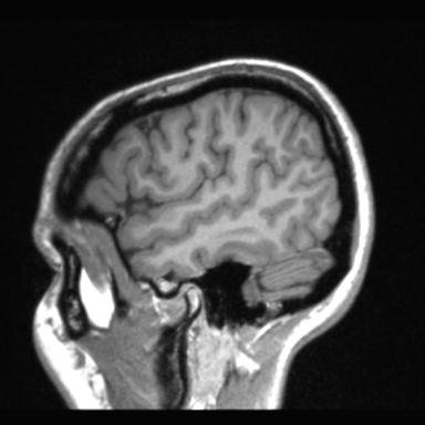 Atretic encephalocoele with inferior vermis hypoplasia (Radiopaedia 30443-31108 Sagittal T1 112).jpg