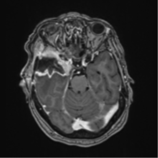 Atypical meningioma (WHO Grade II) (Radiopaedia 54742-60981 Axial T1 C+ 24).png