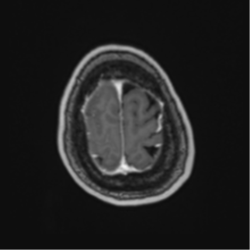 Atypical meningioma (WHO Grade II) (Radiopaedia 54742-60981 Axial T1 C+ 63).png