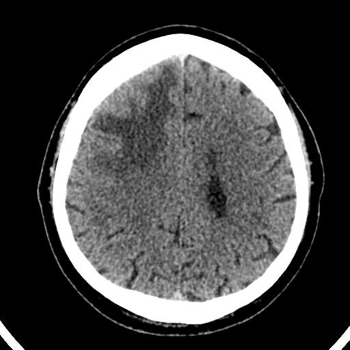 File:Atypical meningioma (WHO grade II) with brain invasion (Radiopaedia 57767-64728 Axial non-contrast 31).png