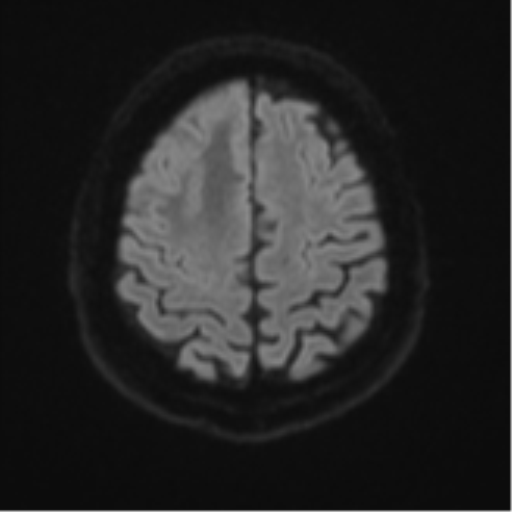 Atypical meningioma (WHO grade II) with brain invasion (Radiopaedia 57767-64729 Axial DWI 54).png