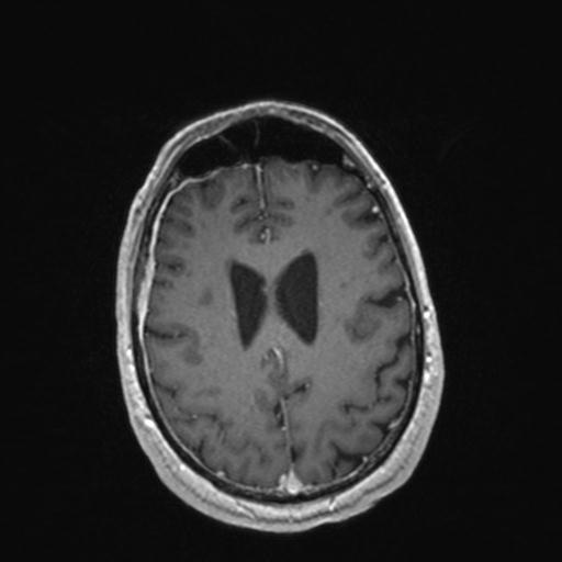 Atypical meningioma (grade II) - en plaque (Radiopaedia 29633-30147 Axial T1 C+ 130).jpg