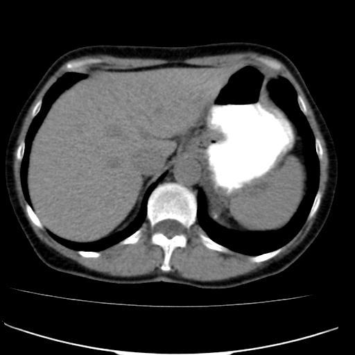 File:Atypical renal cyst (Radiopaedia 17536-17251 non-contrast 2).jpg