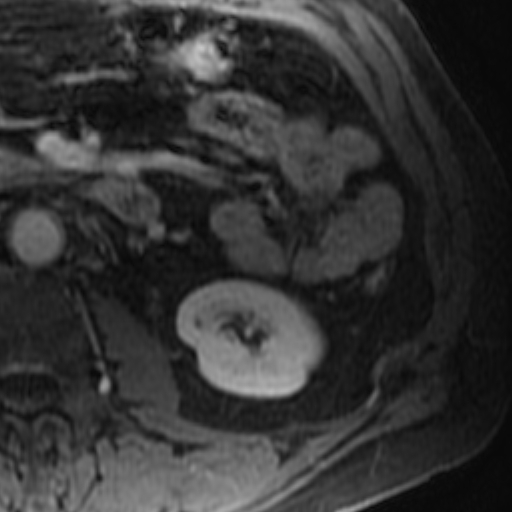 File:Atypical renal cyst on MRI (Radiopaedia 17349-17046 D 24).jpg