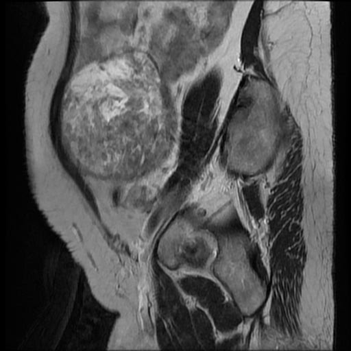 File:Atypical retroperitoneal lymphocoeles with large leiomyoma of uterus (Radiopaedia 32084-33027 Sagittal T2 26).jpg