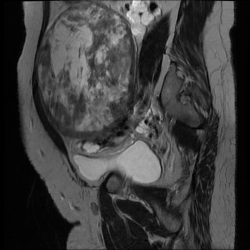 File:Atypical retroperitoneal lymphocoeles with large leiomyoma of uterus (Radiopaedia 32084-33027 Sagittal T2 9).jpg