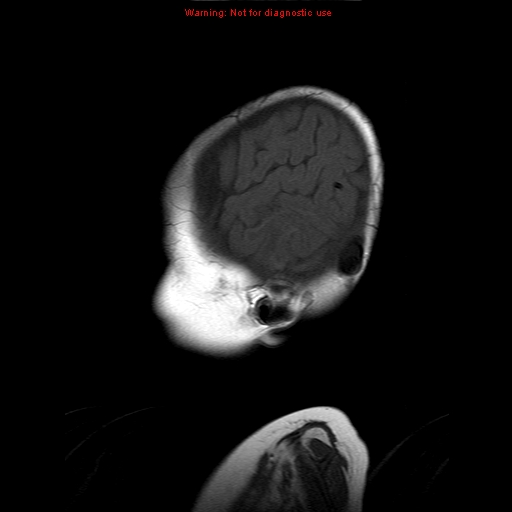 File:Atypical teratoid rhabdoid tumor (Radiopaedia 10712-11183 Sagittal T1 2).jpg