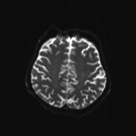 File:Autoimmune limbic encephalitis (Radiopaedia 30363-31005 Axial B0 and DWI 24).jpg