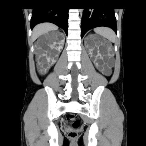 Autosomal dominant polycystic kidney disease (Radiopaedia 66349-75582 A 66).jpg