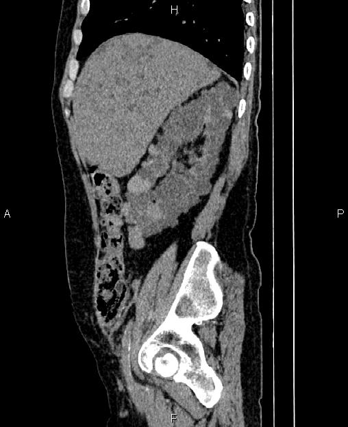 Autosomal dominant polycystic kidney disease (Radiopaedia 87830-104287 C 22).jpg