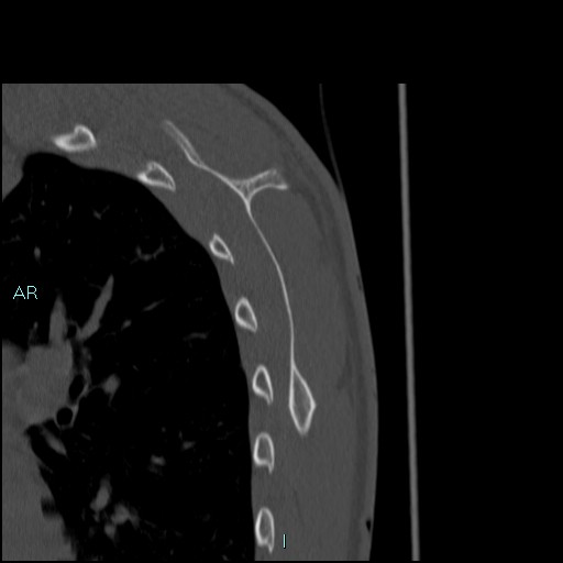 Avascular necrosis after fracture dislocations of the proximal humerus (Radiopaedia 88078-104653 Sagittal bone window 72).jpg