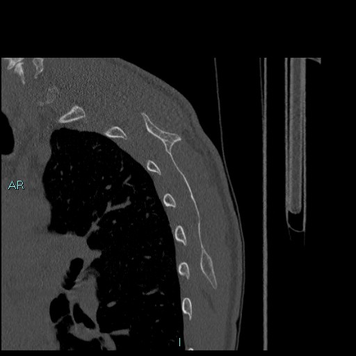 Avascular necrosis after fracture dislocations of the proximal humerus (Radiopaedia 88078-104655 Sagittal bone window 75).jpg