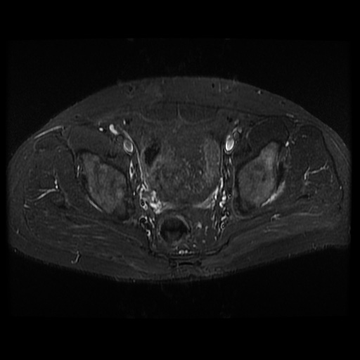 File:Avascular necrosis of the hip (Radiopaedia 61503-69465 Axial STIR 12).jpg