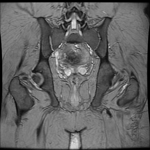 Avascular necrosis of the hip (Radiopaedia 61503-69465 F 70).jpg