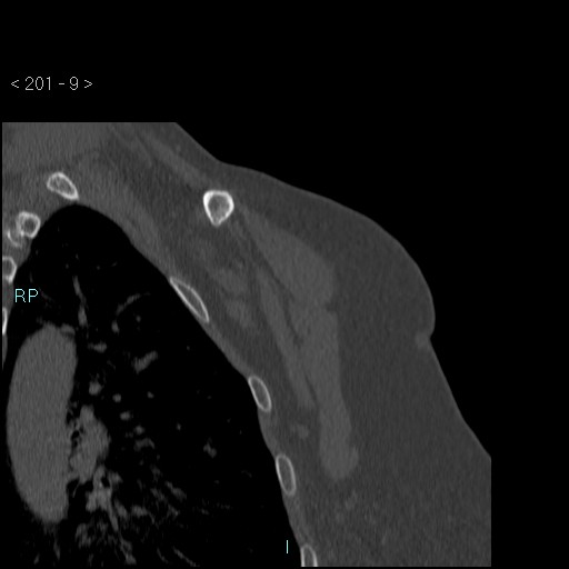 Avascular necrosis of the shoulder - Cruess stage I (Radiopaedia 77674-89887 Coronal bone window 8).jpg