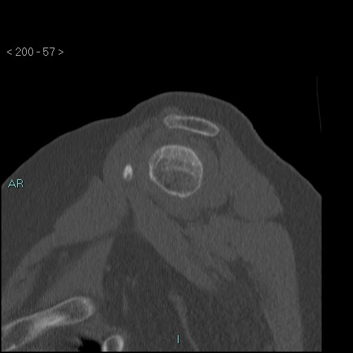 Avascular necrosis of the shoulder - Cruess stage I (Radiopaedia 77674-89887 Sagittal bone window 56).jpg
