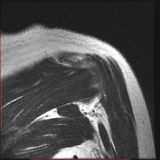 File:Avulsion fracture - greater tuberosity of humerus (Radiopaedia 25457-25703 Coronal T2 12).jpg