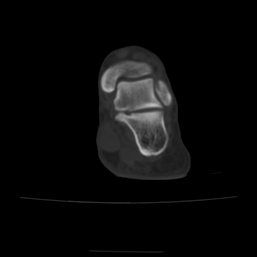 Avulsion fracture of the dorsal cuboid bone (Radiopaedia 51586-57377 Axial bone window 23).jpg