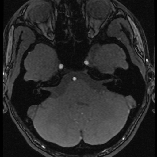 Azygos anterior cerebral artery (Radiopaedia 17059-16756 Axial MRA 69).jpg