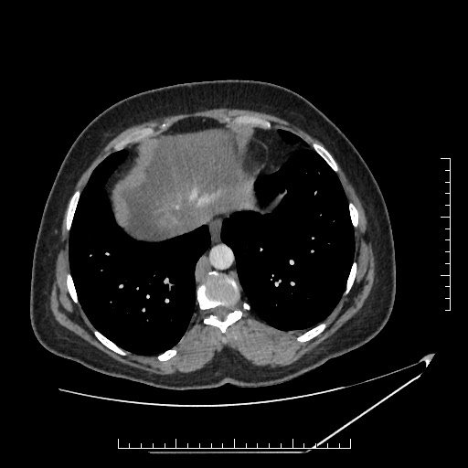 File:Azygos continuation of the IVC (Radiopaedia 40416-42965 A 5).jpg