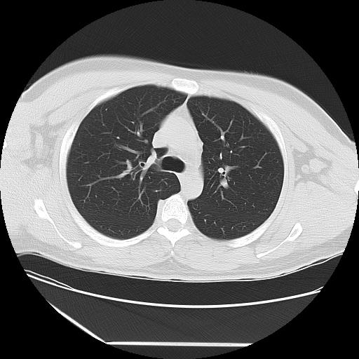 Azygos fissure (Radiopaedia 88181-104784 Axial lung window 16).jpg