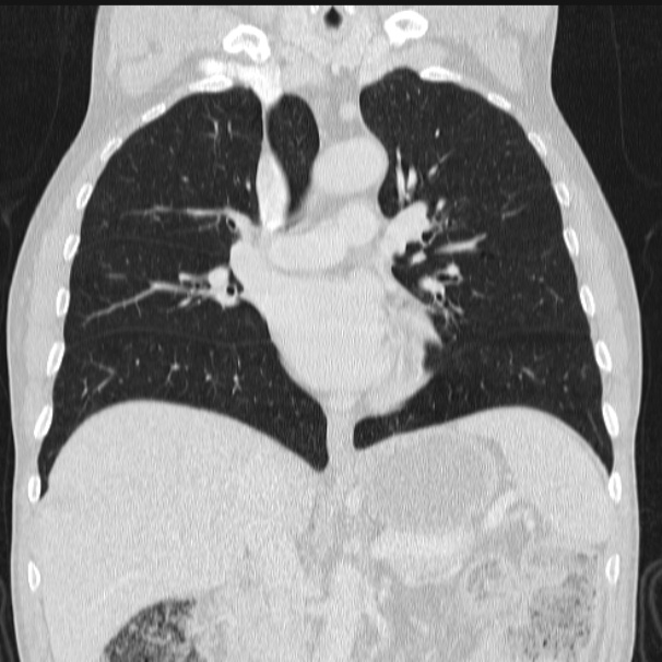 Azygos lobe (Radiopaedia 38259-40275 Coronal lung window 39).jpg