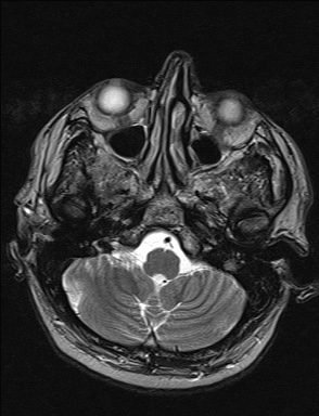 File:Balo concentric sclerosis (Radiopaedia 50458-55940 Axial T2 37).jpg