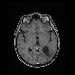 File:Balo concentric sclerosis (Radiopaedia 53875-59982 Axial LAVA C+ 132).jpg