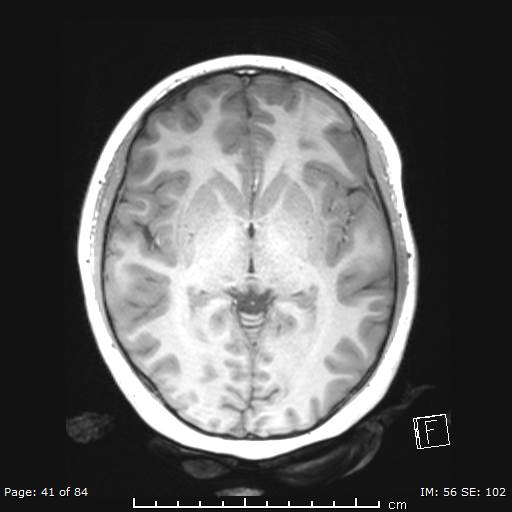 File:Balo concentric sclerosis (Radiopaedia 61637-69636 Axial T1 41).jpg