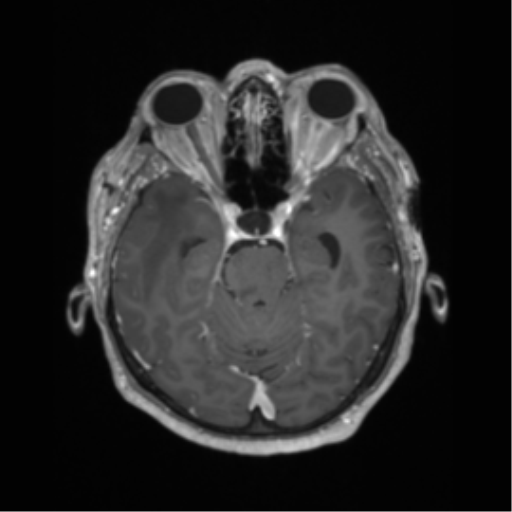 Basal ganglia metastasis (Radiopaedia 78928-91828 Axial T1 C+ 24).png