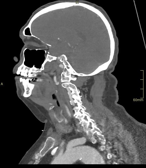 Basilar artery aneurysm (Radiopaedia 56261-62932 C 42).jpg