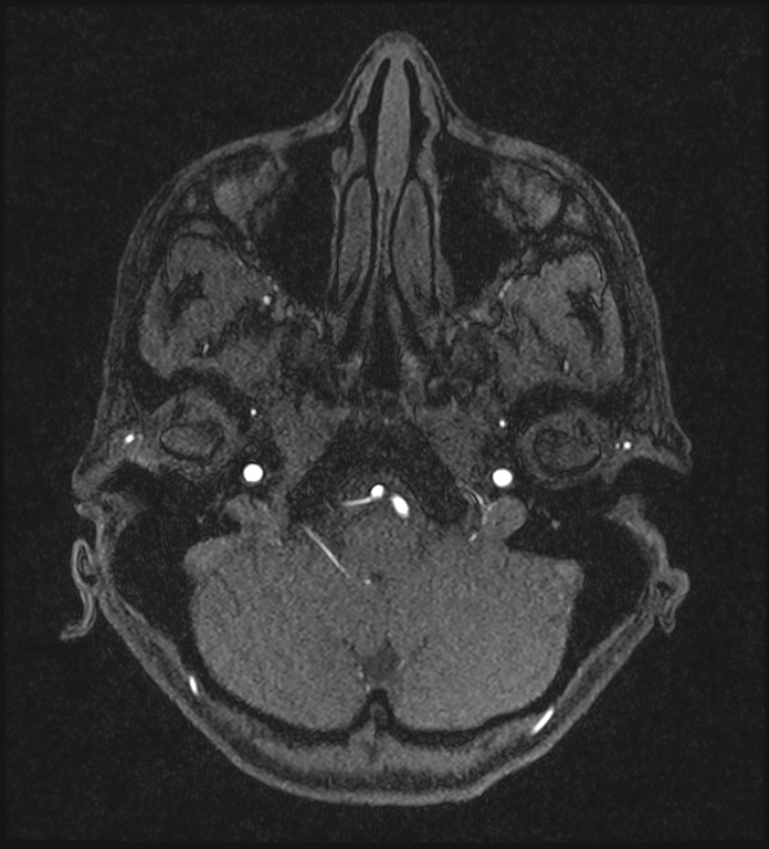 Basilar artery perforator aneurysm (Radiopaedia 82455-97733 Axial MRA 43).jpg