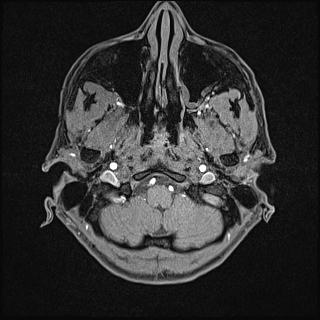 Basilar artery perforator aneurysm (Radiopaedia 82455-97733 Axial T1 fat sat 12).jpg