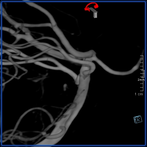 Basilar artery perforator aneurysm (Radiopaedia 82455-99524 3D Left VA 69).jpg