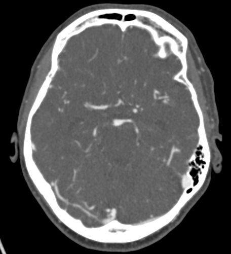 Basilar tip aneurysm with coiling (Radiopaedia 53912-60086 A 57).jpg