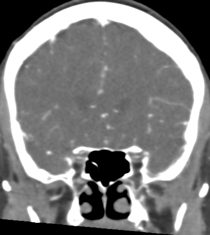 Basilar tip aneurysm with coiling (Radiopaedia 53912-60086 B 47).jpg
