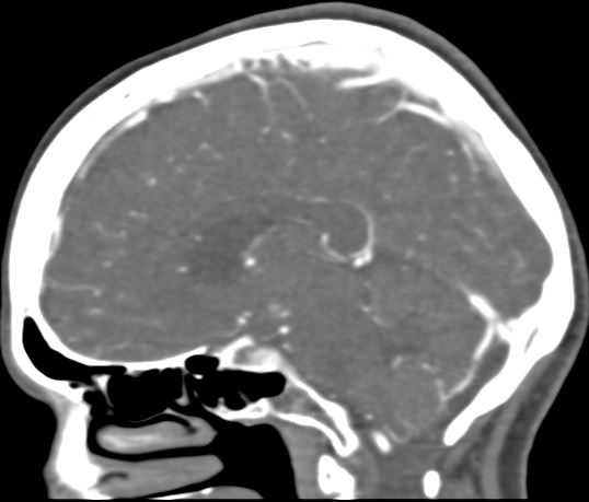 Basilar tip aneurysm with coiling (Radiopaedia 53912-60086 C 72).jpg
