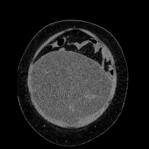 File:Benign leiomyoma with hydropic features (Radiopaedia 89250-106130 B 25).jpg