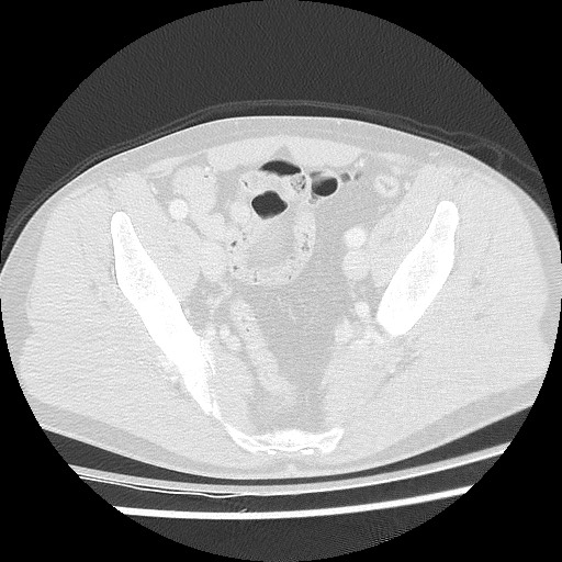 Benign post-traumatic pseudopneumoperitoneum (Radiopaedia 71199-81495 Axial lung window 123).jpg
