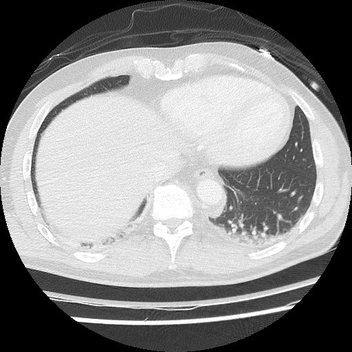 Benign post-traumatic pseudopneumoperitoneum (Radiopaedia 71199-81495 Axial lung window 56).jpg
