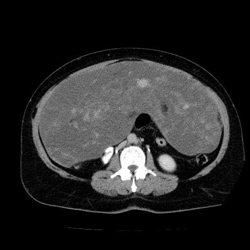 Benign spindle cell tumor - abdominopelvic (Radiopaedia 61300-69212 Axial C+ delayed 32).jpg