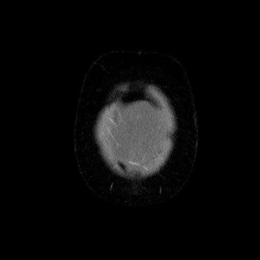 File:Benign spindle cell tumor - abdominopelvic (Radiopaedia 61300-69212 C 5).jpg